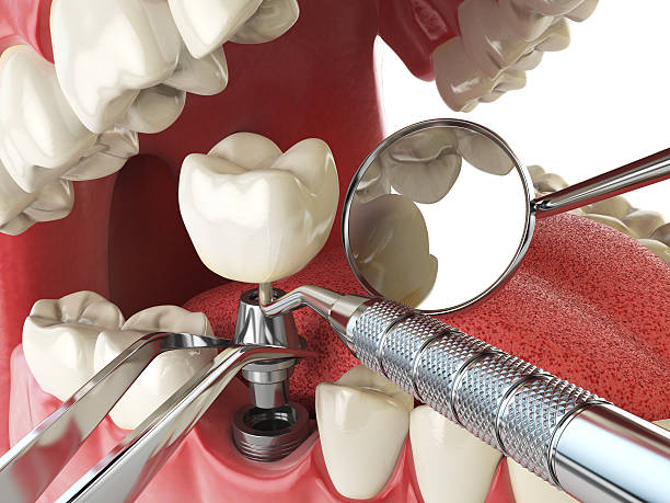 Best Root Canal Emergency Dentist  in Dexter, GA